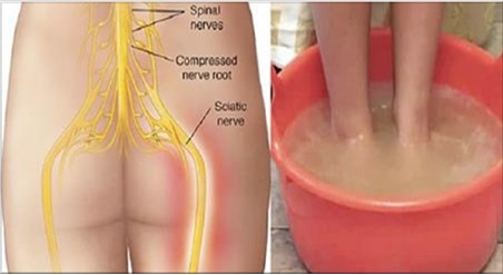 Recette Facile | Vous souffrez de douleurs du nerf sciatique? dire au revoir à ces douleurs avec cette méthode naturelle rapidement et en toute sécurité