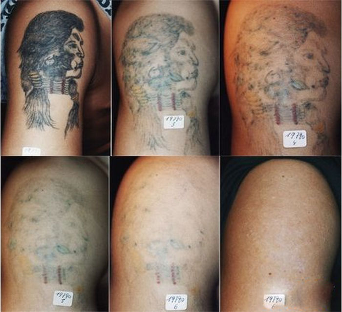 Recette Facile | Comment enlever un tatouage à la maison ?