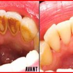 Une astuce pour supprimer le tartre rapidement